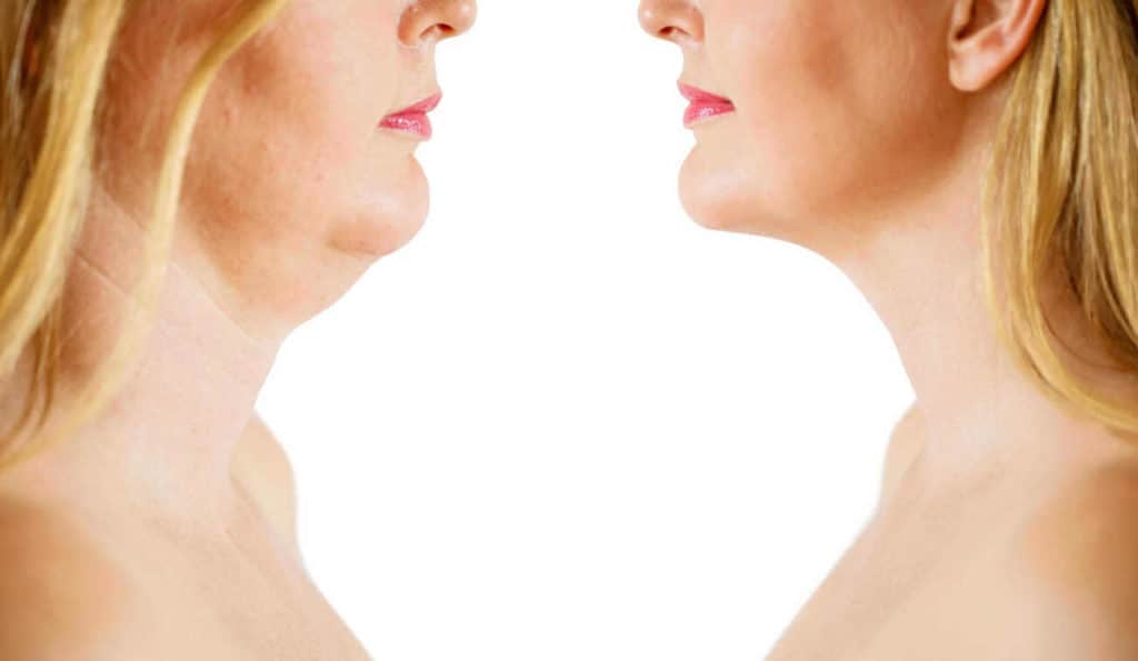 Double Chin treatment Whitley Bay before and after results