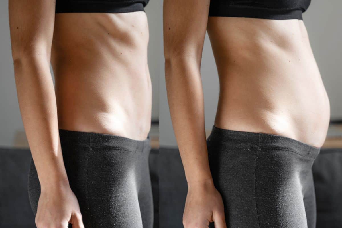 How long does diastasis recti take to improve Whitley Bay?