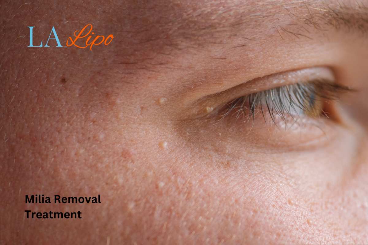 Cryopen Milia Removal: Is It the Easiest and Safest Option Whitley Bay?