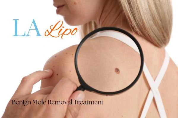 Why getting moles removed Whitley Bay can boost your confidence!