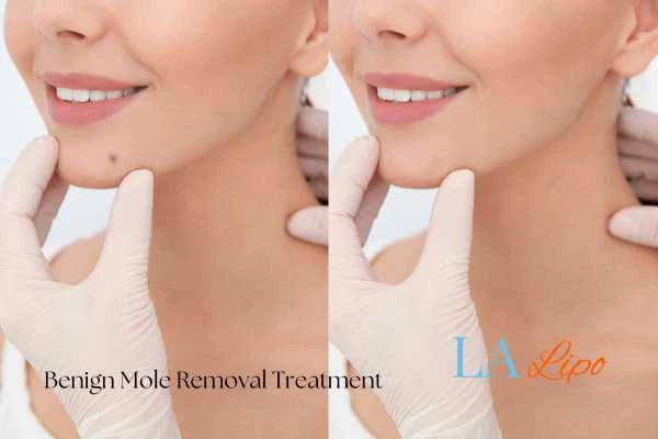 woman's before and after mole removal Whitley Bay results