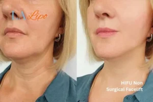 hi-fu for wrinkles Whitley Bay before and after results