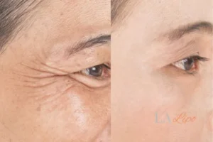 Before and after results of woman - HI-fu wrinkles reduction treatment Whitley Bay