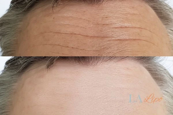 results of HIFU Whitley Bay on mans forehead to help reduce lines and wrinkles