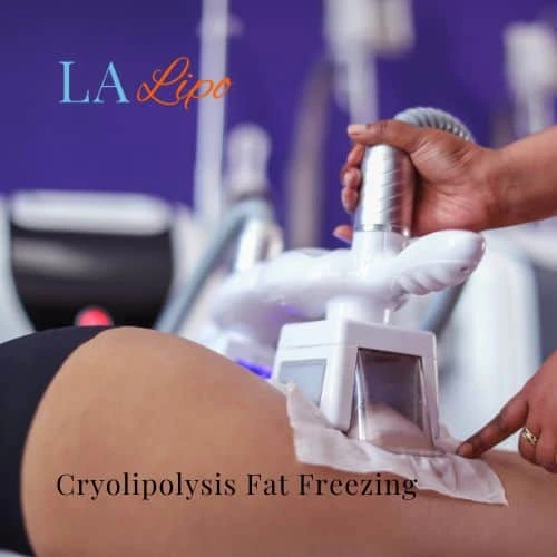 fat freezing - Cryolipolysis Whitley Bay