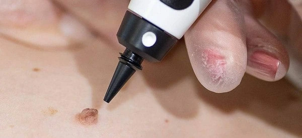 skin tag removal using cryopen Whitley Bay