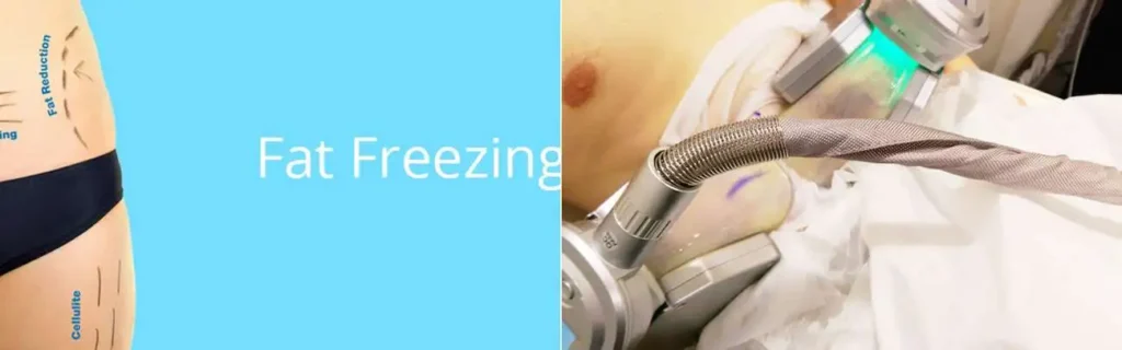 Fat freezing Whitley Bay on multiple areas of the body