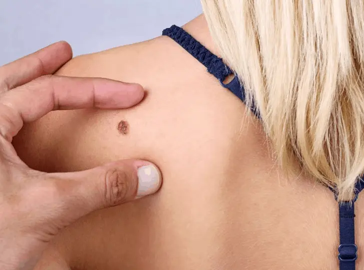 woman having mole removal Whitley Bay consultation before treatment.