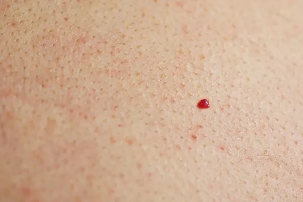 close up of a cherry angioma Whitley Bay