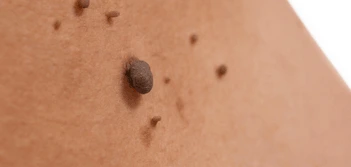 image of a skin tag Whitley Bay