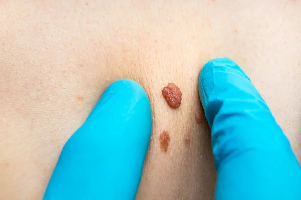 Consultant examining a skin tag Whitley Bay
