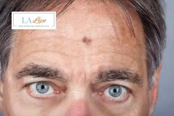 Solar Lentigo Removal Whitley Bay image of man with mark on his forehead