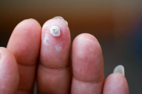 wart on person finger - cryotherapy to treat from LA LIPO Whitley Bay
