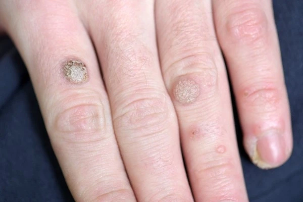 photo of warts on person hand - see wart removal Whitley Bay from LA LIPO