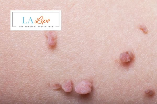 Does cryopen skin tag removal Whitley Bay hurt? Find out now call our team today!