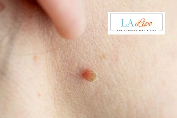 Book skin tag removal Whitley Bay today speak to our team now!