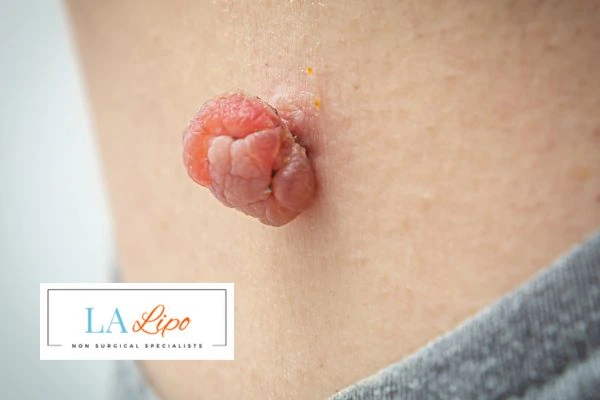 Interested in skin tag removal Whitley Bay? Concerned about the pain? Find out more today!
