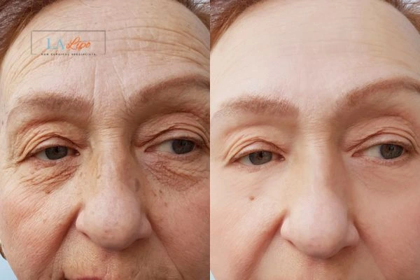 The powerful benefits of Morpheus8 Treatment Whitley Bay - Call Our team today!