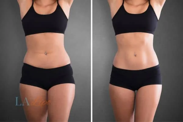 before and after results of non-surgical treatment to help a woman's body image and mental health Whitley Bay