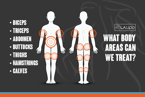 Diagram to show areas you can have LA-EMS Body Sculpting Treatment Whitley Bay