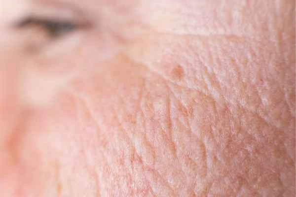 close up picture of a woman's face showing an age spot Whitley Bay
