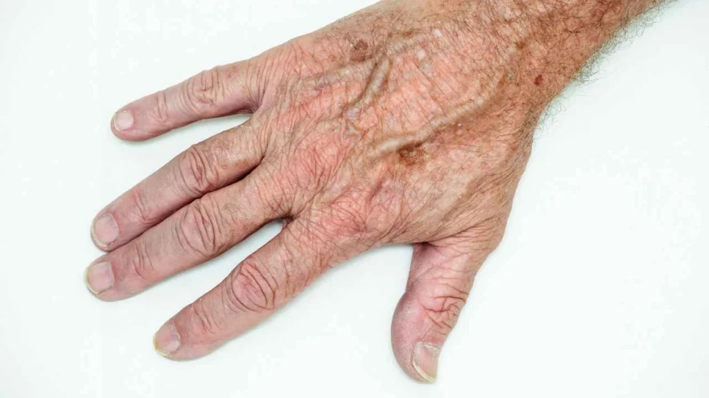 Male hand showing age spot Whitley Bay