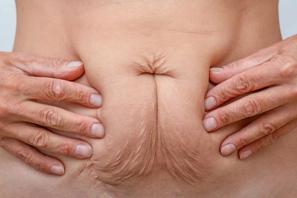 Image of a woman's stomach with loose skin - example of skin tightening Whitley Bay options