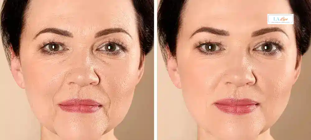 How Long Does It Take to See Results and How Long Do They Last Whitley Bay?