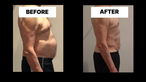 What Symptoms Can Diastasis Recti Cause in Men? Weak Core, Back Pain and Poor Posture Whitley Bay